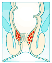 Hämorrhoiden Stadium I