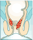 Hämorrhoiden Stadium II