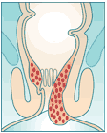 Hämorrhoiden Stadium IV