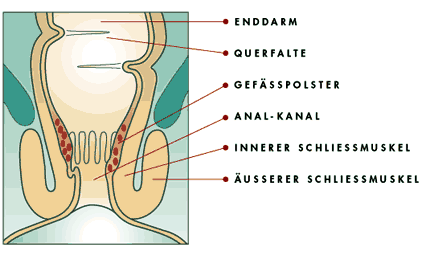 Steißbein fisteln am Steißbeinfistel Erfahrung: